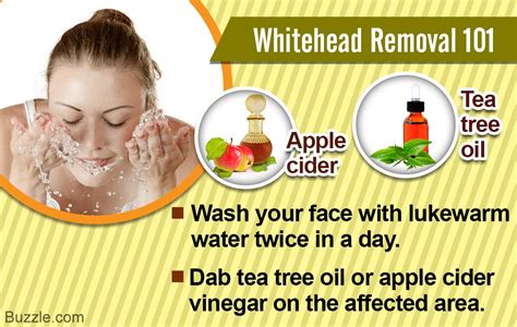 Pin By Cora On Diy Health And Beauty Whitehead Removal Whitehead How