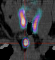 The most common indication for lung scintigraphy is to diagnose pulmonary embolism, e.g. Indications de la scintigraphie parathyroidienne