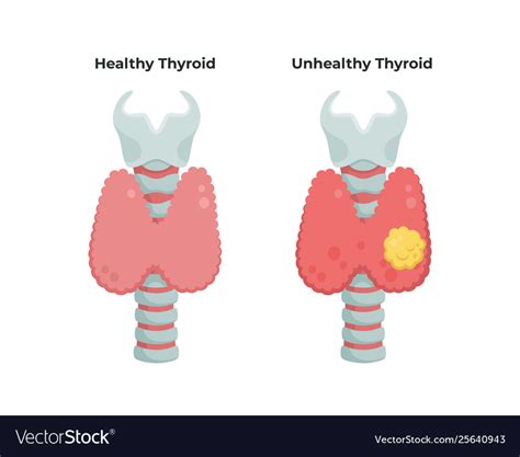 Healthy Thyroid Gland And Unhealthy Thyroid Vector Image