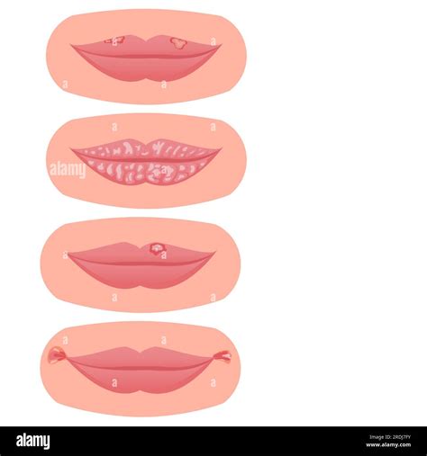 Lip Disorders Illustration Stock Photo Alamy