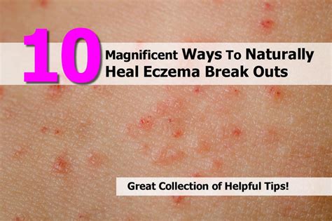 10 Magnificent Ways To Naturally Heal Eczema Break Outs