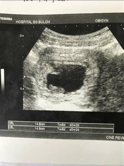 Shows The Initial Pelvic Ultrasound Finding Of Missed Miscarriage At 10