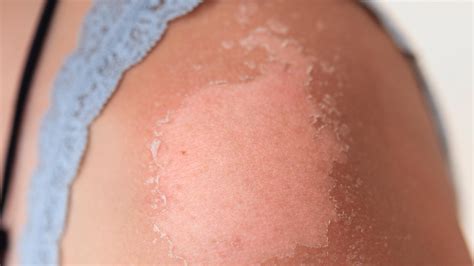 Why Your Skin Peels After A Sunburn According To Dermatologists Allure