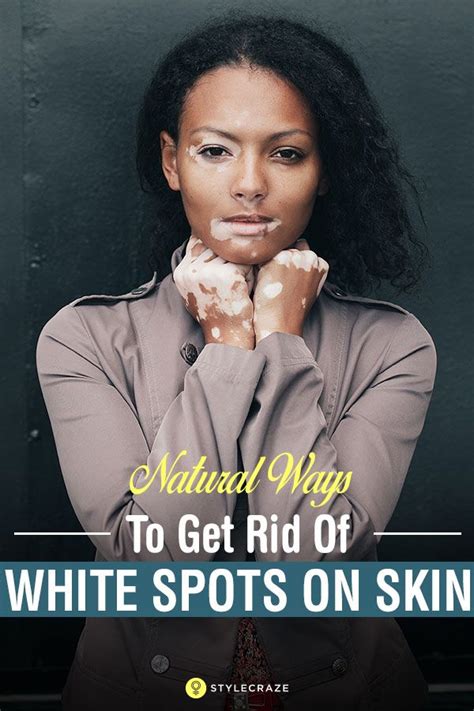 21 Natural Ways To Get Rid Of White Spots On Skin Vitiligo Skin