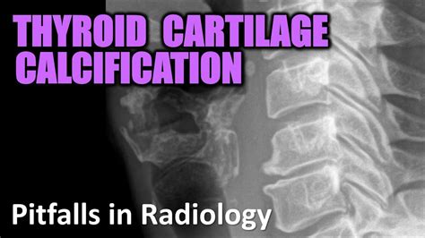 Thyroid Cartilage Calcification Pitfalls In Radiology Radiology