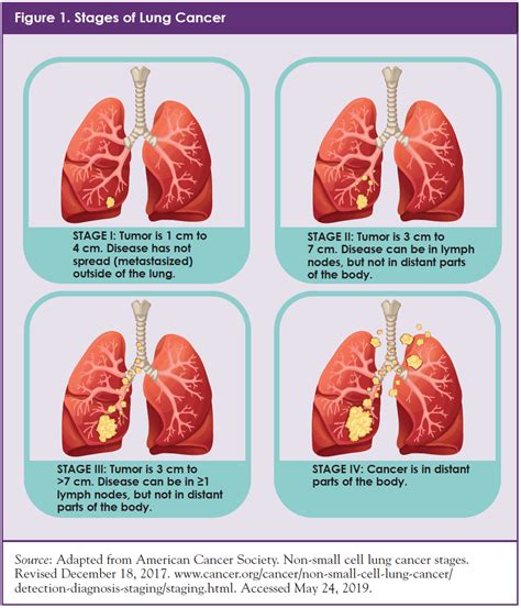 Stage iv non — small cell lung cancer is very difficult to treat because it has spread to distant sites throughout the body. Personalizing Treatment for Patients with Non-Small-Cell ...