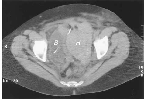 Figure 1 From Vascular Injury During TensionFree Vaginal Tape