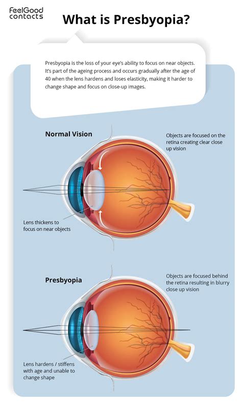 Why Is Presbyopia Feel Good Contacts