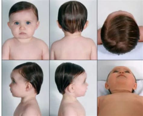 How To Assess Your Babys Head Shape Cranial Technologies