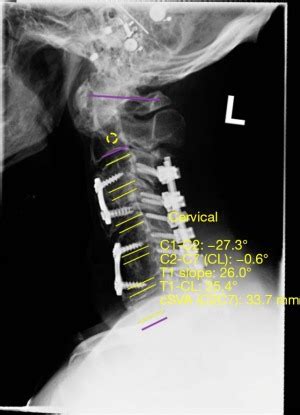 Clinical And Radiographic Benefits Of Skipping C Instrumentation In