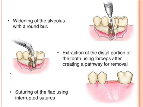 Principles And Steps Of Surgical Tooth Extraction