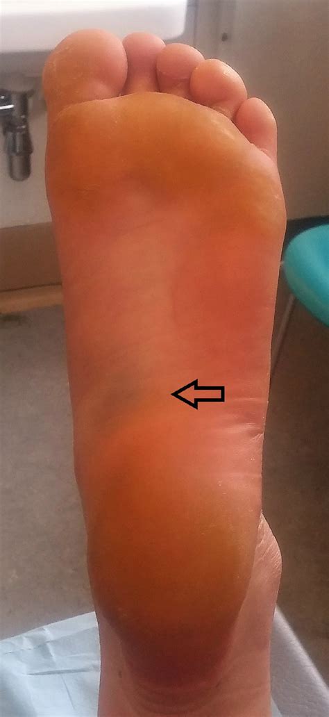 Clinical Appearance After Plantar Fascia Rupture With Bruising And