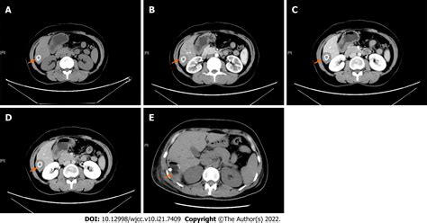Solitary necrotic nodules of the liver with "ring"-like calcification