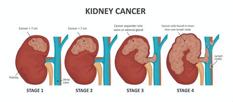 Kidney Renal Cancer Signs Diagnosis And Treatment In Singapore Pcc