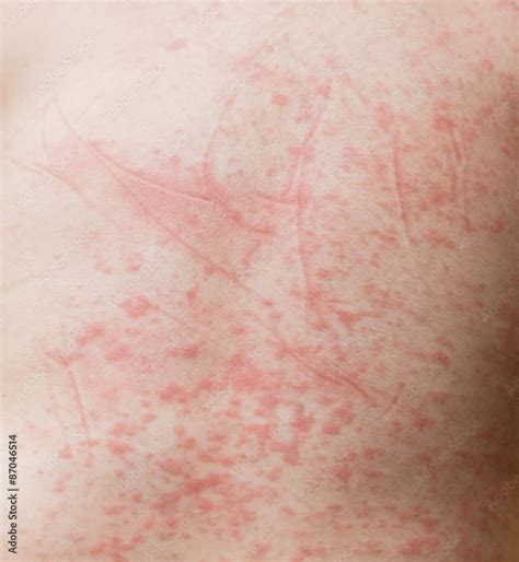 Red Spots On Babys Skin Due To Dengue Virus Dengue Hemorrhagic Fever