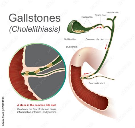 Gallstones Cholelithiasis A Stone In The Common Bile Duct Gallstones