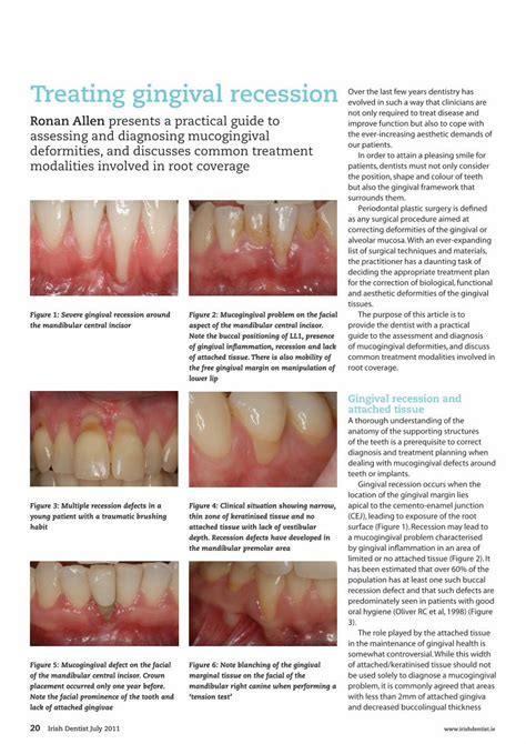 PDF Treating Gingival Recession DOKUMEN TIPS