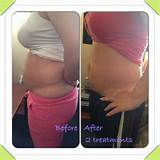 Pictures of Cavi Lipo Treatment