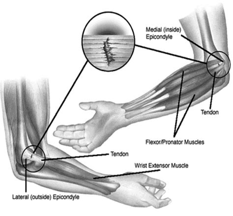 After 1 year eight out of ten people with tennis elbow will have improvement or symptoms that have rehab for tennis elbow : Tennis Elbow: Tennis isn't the only culprit - Physiosteps