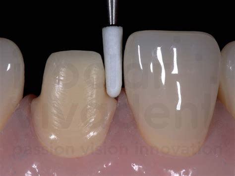 Ips Emax Preparación Dental Dental Crowns Esthetic Dentistry