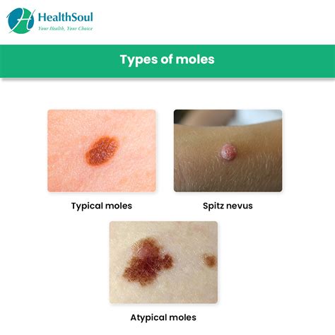 Moles Symptoms Types Diagnosis And Treatment Healthsoul