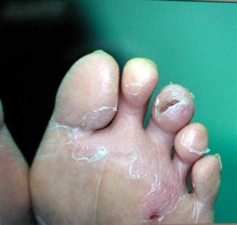 To treat wounds effectively, make sure that all the medical supplies and tools you will use are clean, dry, and disinfected. Diabetic Foot Ulcers - Case 2