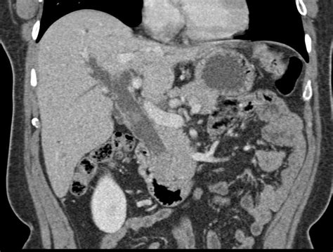 Dilated Common Bile Duct With Impacted Stone Liver Case Studies