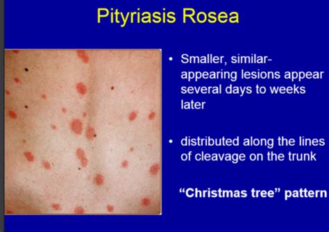 Pityriasis Rosea Christmas Tree Pattern