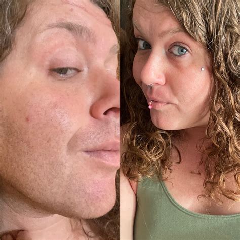 32yo MtF 6 months HRT w/ 6 treatments of laser hair removal : r