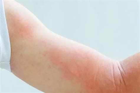 How To Get Rid Of A Rash