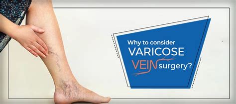 Why To Consider Varicose Vein Surgery