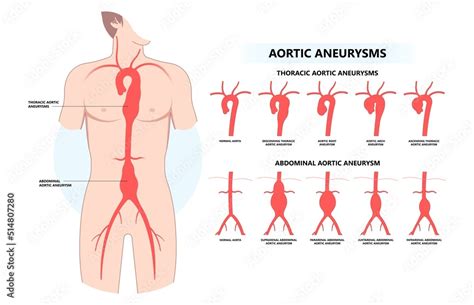 Left Aorta Root Bulge Heart Blood Vessel Clots Aortic Arch Damage And