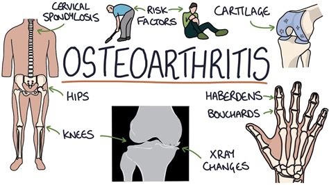 Symptoms Of Osteoarthritis And Treatment