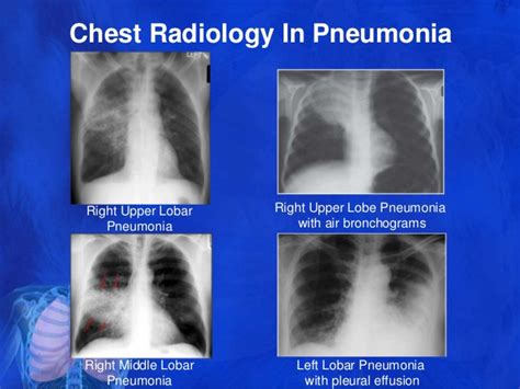 Pleural Effusion Vs Pneumonia X Ray Yahoo Image Search Results