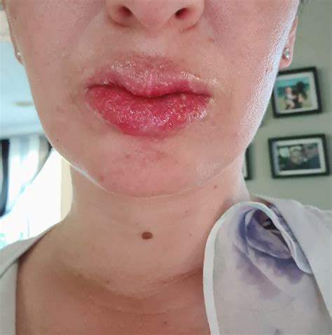 Please Help Tiny Bumps Blisters On Lips Day Of Accutane