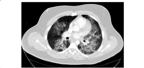 Axial Ct Chest Scan With Iv Contrast Diffuse Bilateral Ground Glass