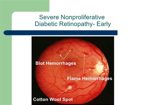 Modest association with risk of clinical stroke, subclinical stroke, coronary heart disease, and death. Diabetic eye disease