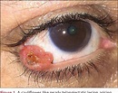Figure 1 from Sebaceous Gland Carcinoma with Misleading Clinical ...