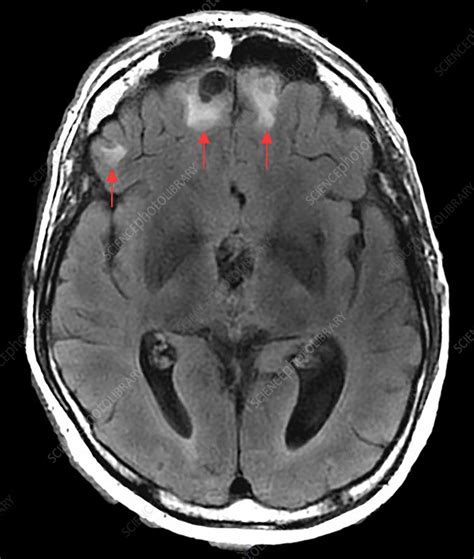 Chronic Post Traumatic Brain Injury Mri Stock Image C0306070