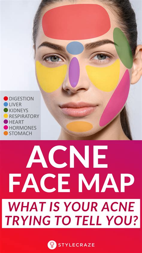 Acne Face Map What Your Breakouts Are Trying To Tell You Face Acne