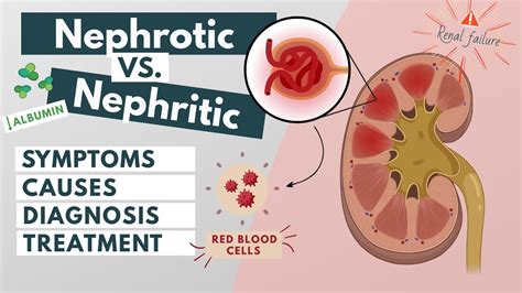 Nephrotic Vs Nephritic Syndrome Symptoms Diagnosis Causes