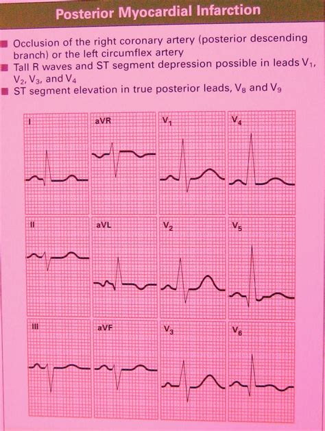 How To Read Ecg Location Of Mi By Ecg Leads