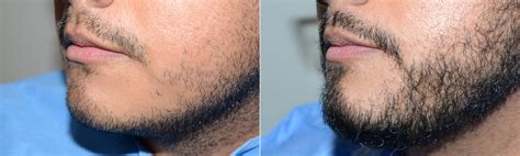 Facial Hair Transplant Before And After Photos Foundation For Hair Restoration