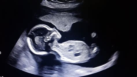 19 Week Ultrasound