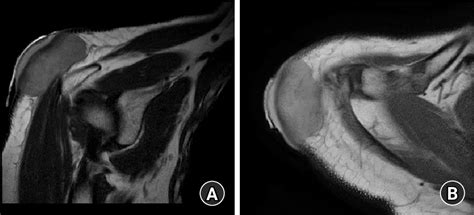Figure 3 From Interdigitating Dendritic Cell Sarcoma In Upper Arm
