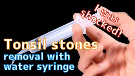 Tonsil Stones Removal With Water Syringe Youtube