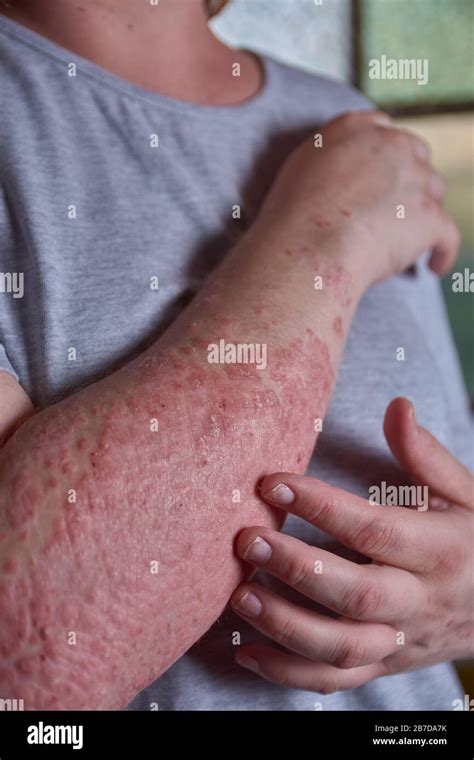 Forearm View Of Woman With Psoriasis Stock Photo Alamy