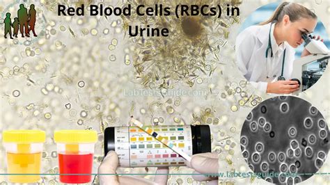 Red Blood Cells Rbcs In Urine Causes Diagnosis And More Lab Tests