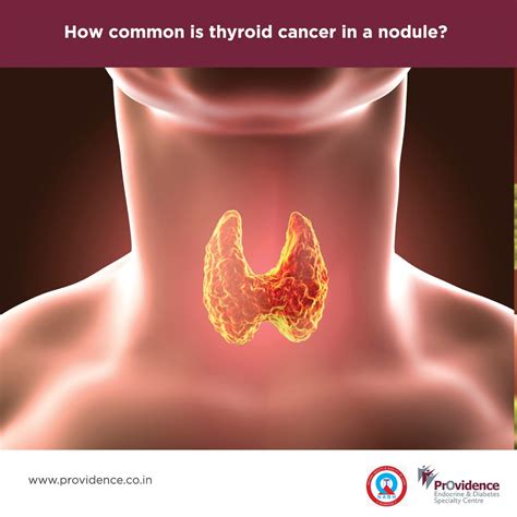 Thyroid