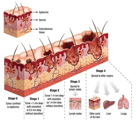 Skin Cancer Stages Source Download Scientific Diagram